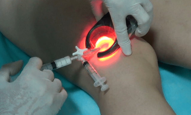 Die Sklerotherapie ist eine wirksame Methode zur Behandlung von Krampfadern an den Beinen